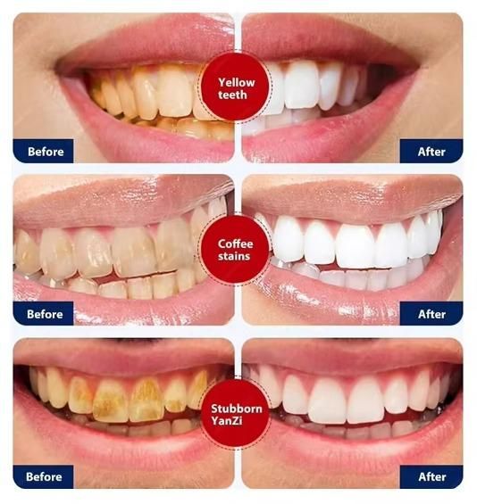 Before and after results of teeth whitening using Smoke Stains White Plus Toothpaste 200g Pack of 2.