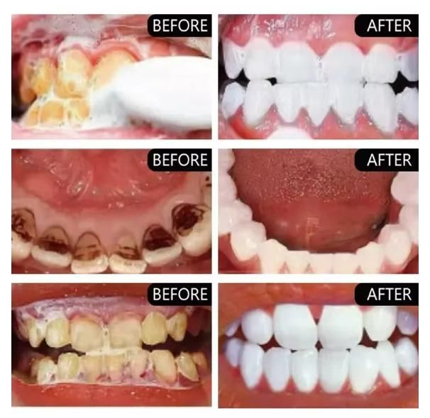 Before and after results of using Smoke Stains White Plus Toothpaste 200g Pack of 2 for teeth whitening and stain removal.